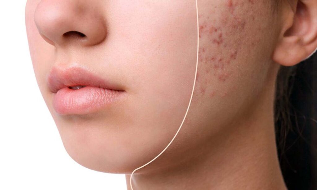 deri alti sivilce nasil gecer