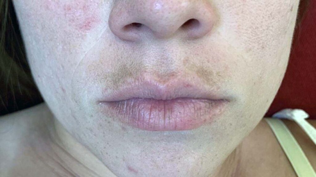 dudak ustu kararmasi