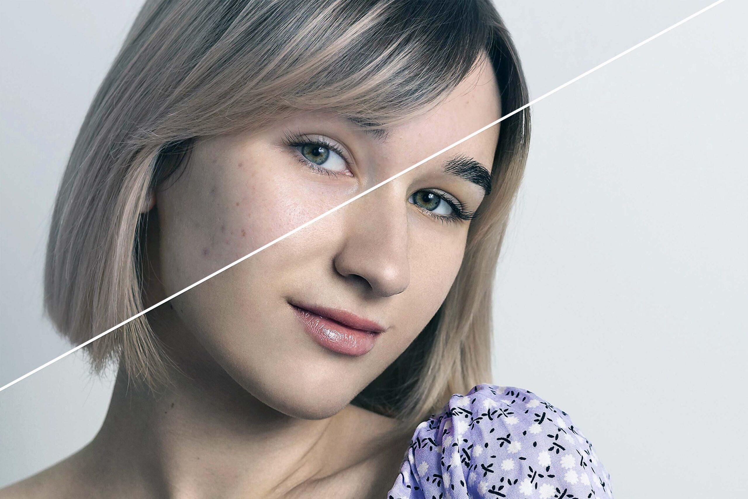 yüzdeki gözenekler nasıl temizlenir