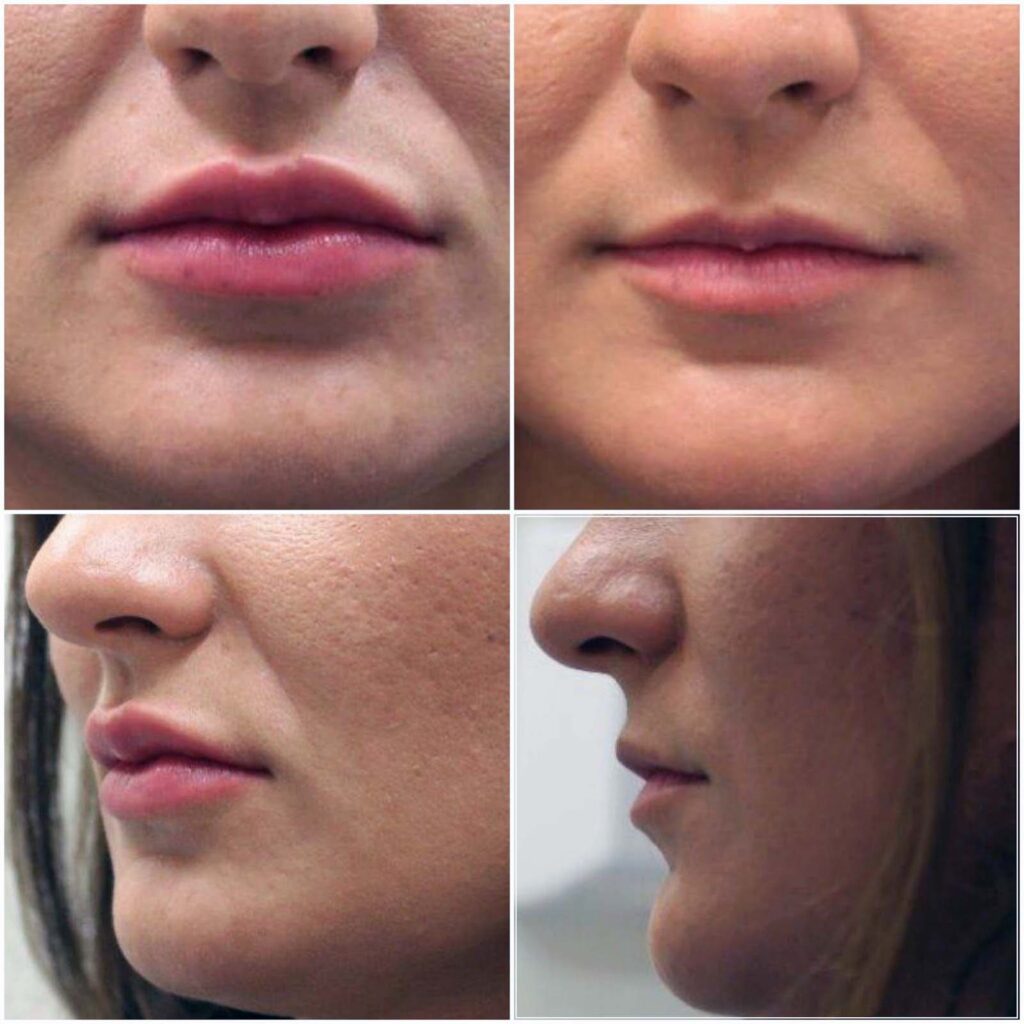 dudak dolgusu hakkında tüm merak edilenler 2 dudak dolgusu oncesi sonrasi
